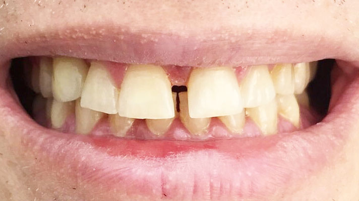 Zwischen den zahnlücke schneidezähnen grosse Diastema: Zahnlücke